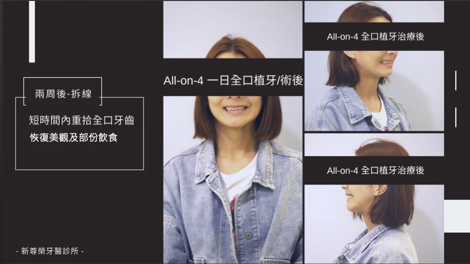 All-on-4/6一日全口重建 All-on-4/6一日全口重建