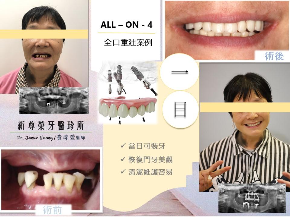 All-on-4/6一日全口重建 All-on-4/6一日全口重建