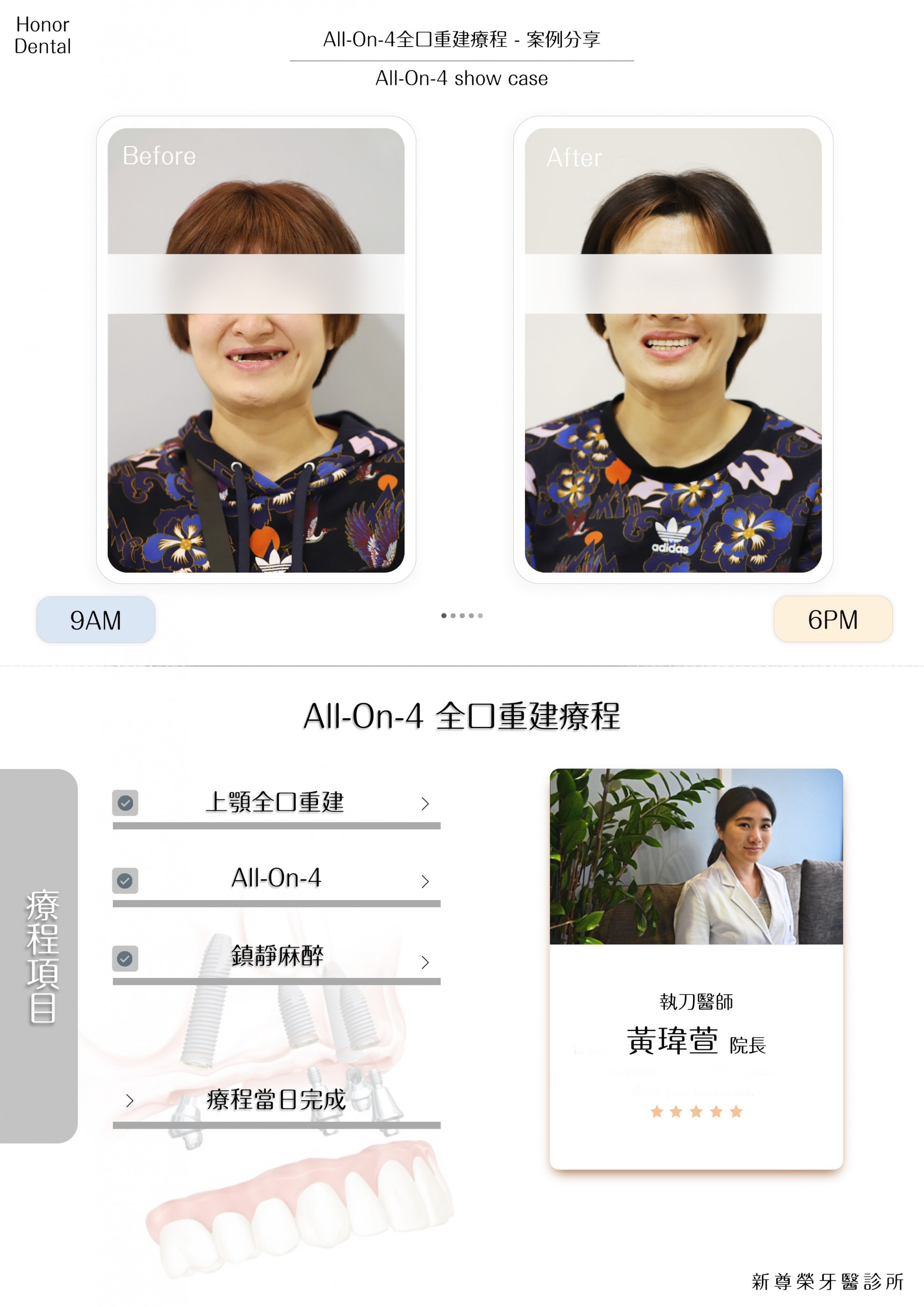 All-on-4/6一日全口重建 All-on-4/6一日全口重建