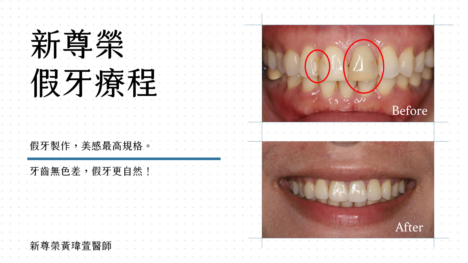 全瓷假牙 全瓷假牙
