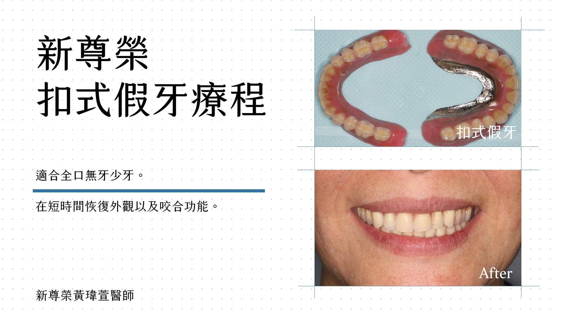 全瓷假牙 全瓷假牙